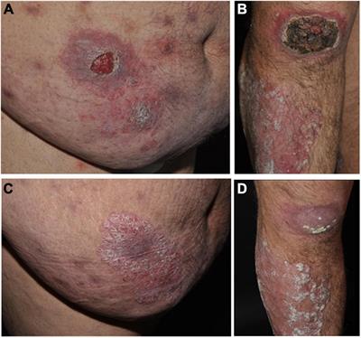 Case report: Cutaneous pseudolymphoma caused by a Leishmania infantum infection in a patient treated with anti-TNF antibody for plaque psoriasis